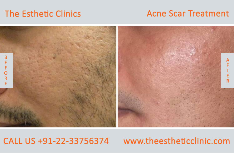 face acne scars removal laser treatment before after photos in mumbai india (2)